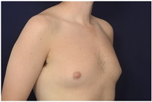 Male Breast Reduction Before Photo by Michael Law, MD; Raleigh, NC - Case 42126