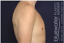 Male Breast Reduction After Photo by Michael Law, MD; Raleigh, NC - Case 42126