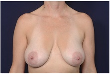 Breast Reduction Before Photo by Michael Law, MD; Raleigh, NC - Case 42134
