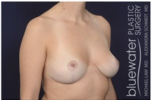 Breast Reduction After Photo by Michael Law, MD; Raleigh, NC - Case 42134