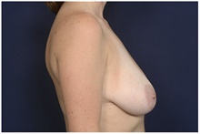 Breast Reduction Before Photo by Michael Law, MD; Raleigh, NC - Case 42134