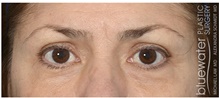 Eyelid Surgery After Photo by Michael Law, MD; Raleigh, NC - Case 42135