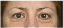 Eyelid Surgery Before Photo by Michael Law, MD; Raleigh, NC - Case 42135
