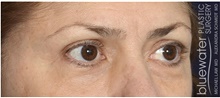 Eyelid Surgery After Photo by Michael Law, MD; Raleigh, NC - Case 42135