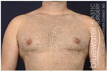 Male Breast Reduction After Photo by Michael Law, MD; Raleigh, NC - Case 42157