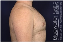 Male Breast Reduction After Photo by Michael Law, MD; Raleigh, NC - Case 42157