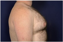 Male Breast Reduction Before Photo by Michael Law, MD; Raleigh, NC - Case 42157