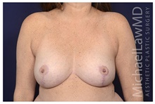 Breast Reduction After Photo by Michael Law, MD; Raleigh, NC - Case 42178