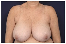 Breast Reduction Before Photo by Michael Law, MD; Raleigh, NC - Case 42178