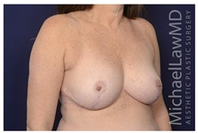 Breast Reduction After Photo by Michael Law, MD; Raleigh, NC - Case 42178