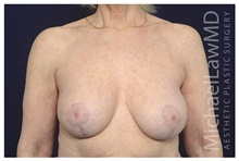 Breast Implant Revision After Photo by Michael Law, MD; Raleigh, NC - Case 42179