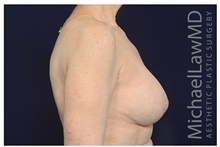 Breast Implant Revision After Photo by Michael Law, MD; Raleigh, NC - Case 42179