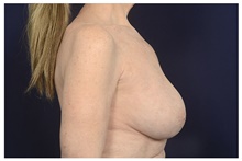 Breast Implant Revision Before Photo by Michael Law, MD; Raleigh, NC - Case 42179