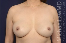 Breast Implant Revision After Photo by Michael Law, MD; Raleigh, NC - Case 42180