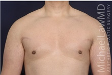 Male Breast Reduction After Photo by Michael Law, MD; Raleigh, NC - Case 42181