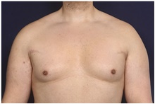 Male Breast Reduction Before Photo by Michael Law, MD; Raleigh, NC - Case 42181