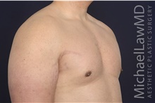 Male Breast Reduction After Photo by Michael Law, MD; Raleigh, NC - Case 42181