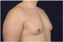 Male Breast Reduction Before Photo by Michael Law, MD; Raleigh, NC - Case 42181