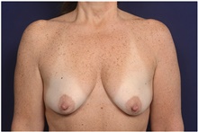 Breast Lift Before Photo by Michael Law, MD; Raleigh, NC - Case 42183