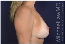 Breast Lift After Photo by Michael Law, MD; Raleigh, NC - Case 42183