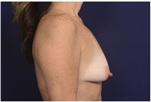 Breast Lift Before Photo by Michael Law, MD; Raleigh, NC - Case 42183