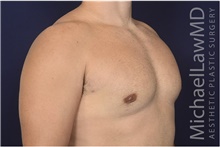 Male Breast Reduction After Photo by Michael Law, MD; Raleigh, NC - Case 42200