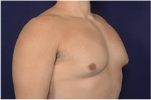 Male Breast Reduction Before Photo by Michael Law, MD; Raleigh, NC - Case 42200