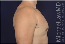 Male Breast Reduction After Photo by Michael Law, MD; Raleigh, NC - Case 42200