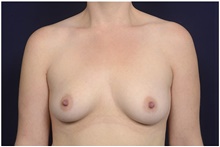 Breast Augmentation Before Photo by Michael Law, MD; Raleigh, NC - Case 42201