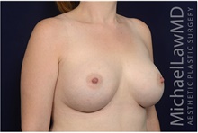 Breast Augmentation After Photo by Michael Law, MD; Raleigh, NC - Case 42201