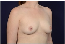 Breast Augmentation Before Photo by Michael Law, MD; Raleigh, NC - Case 42201