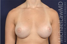 Breast Augmentation After Photo by Michael Law, MD; Raleigh, NC - Case 42203