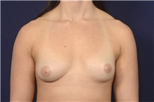 Breast Augmentation Before Photo by Michael Law, MD; Raleigh, NC - Case 42203