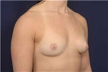 Breast Augmentation Before Photo by Michael Law, MD; Raleigh, NC - Case 42203