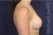 Breast Augmentation After Photo by Michael Law, MD; Raleigh, NC - Case 42203