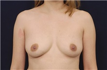 Breast Augmentation Before Photo by Michael Law, MD; Raleigh, NC - Case 42206