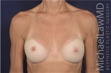 Breast Augmentation After Photo by Michael Law, MD; Raleigh, NC - Case 42207