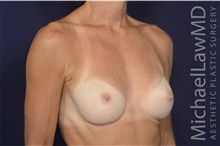 Breast Augmentation After Photo by Michael Law, MD; Raleigh, NC - Case 42207