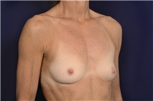 Breast Augmentation Before Photo by Michael Law, MD; Raleigh, NC - Case 42207