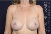Breast Augmentation After Photo by Michael Law, MD; Raleigh, NC - Case 42208