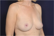 Breast Augmentation Before Photo by Michael Law, MD; Raleigh, NC - Case 42208