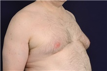 Male Breast Reduction Before Photo by Michael Law, MD; Raleigh, NC - Case 42210