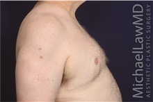 Male Breast Reduction After Photo by Michael Law, MD; Raleigh, NC - Case 42210