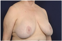 Breast Lift Before Photo by Michael Law, MD; Raleigh, NC - Case 42211