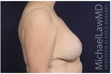 Breast Lift After Photo by Michael Law, MD; Raleigh, NC - Case 42211