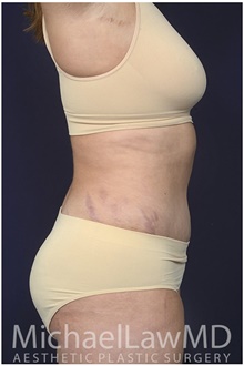 Tummy Tuck After Photo by Michael Law, MD; Raleigh, NC - Case 42212
