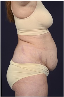 Tummy Tuck Before Photo by Michael Law, MD; Raleigh, NC - Case 42212