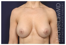 Breast Implant Revision After Photo by Michael Law, MD; Raleigh, NC - Case 42214
