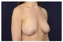 Breast Implant Revision Before Photo by Michael Law, MD; Raleigh, NC - Case 42214