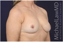 Breast Reduction After Photo by Michael Law, MD; Raleigh, NC - Case 42216